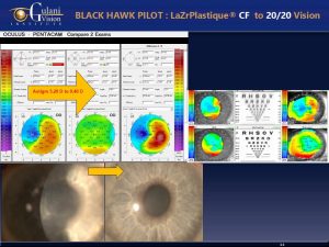 Before and after results of a Black Hawk pilot’s 20/20 vision restoration by Dr. Gulani after corneal scar surgery.