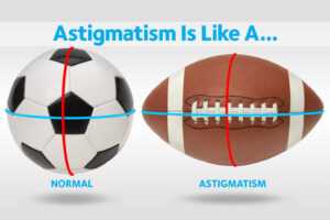 Comparison of astigmatic eye shaped like a football versus a healthy eye shaped like a basketball, illustrating how corneal curvature affects vision clarity.