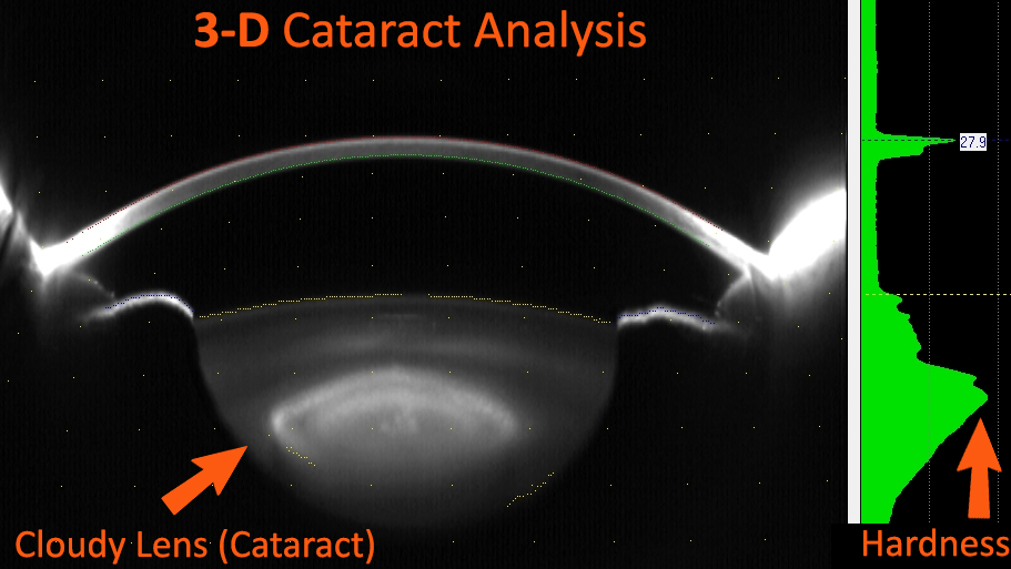 Cataract Pentacam analysis showing detailed corneal mapping and lens opacity before cataract surgery.