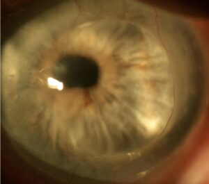 Close-up image of a corneal transplant showing the delicate surgical procedure used to restore vision.