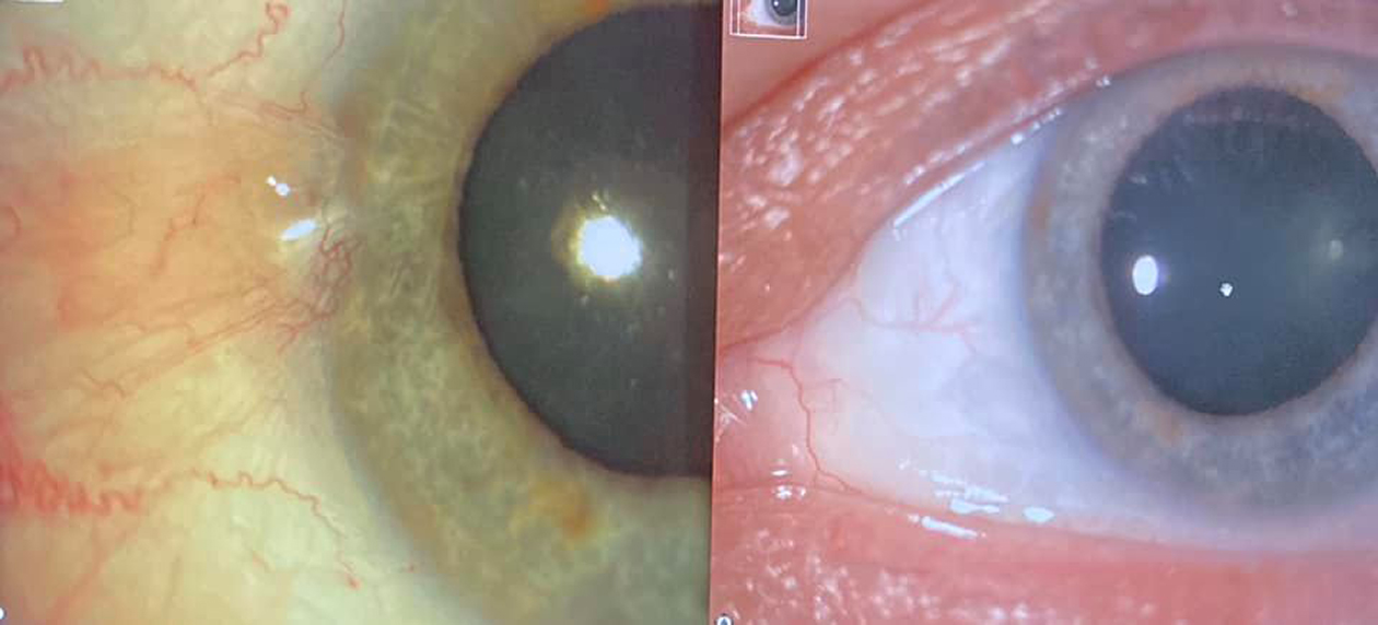 Before and After of An Eye With Pterygium