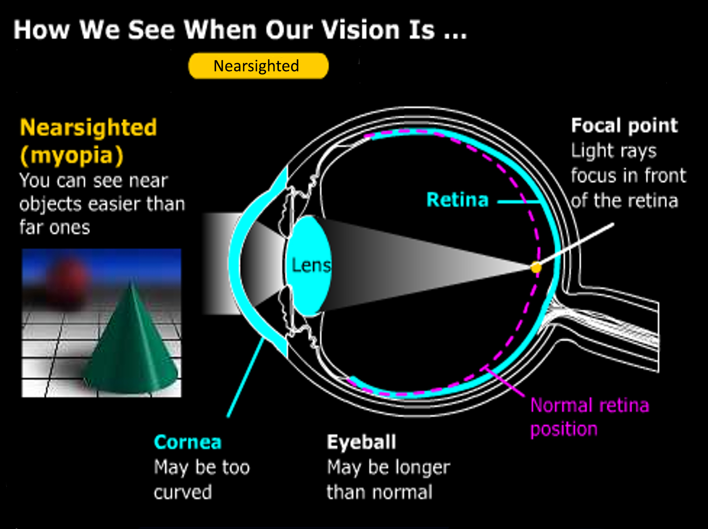 Myopia Jacksonville Gulani Vision Institute