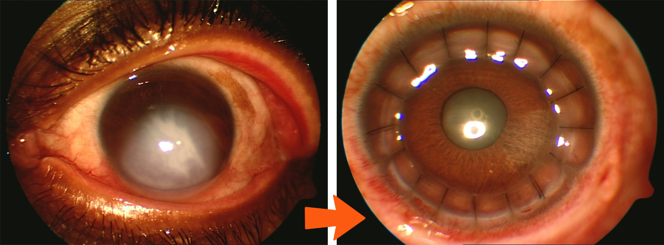 Corneal Transplant Jacksonville Gulani Vision Institute