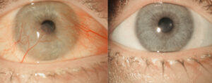 Before-and-after results of Dr. Arun Gulani’s advanced pinguecula surgery, demonstrating the transformation from red, irritated eyes to a clear, natural appearance using his SPARKLE™ technique.