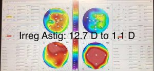 Before and after eye scan showing significant improvement after corneal scar treatment.