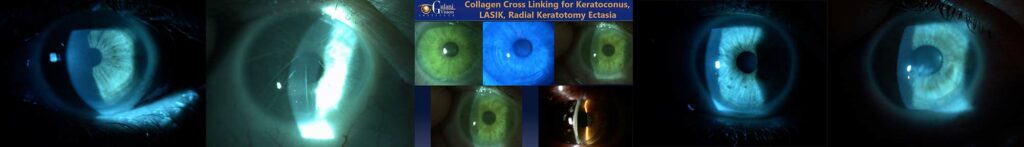 Dr. Gulani performing LazrPlastique® to correct cross-linking-induced corneal scars in a keratoconus patient.