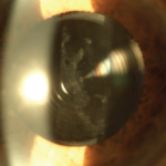 Photo showing Dr. Gulani refining the corneal surface during a non-invasive cataract surgery complication correction.