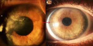 Comparison of corneal scar appearance before and after surgery highlighting dramatic visual improvement.