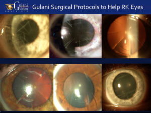 A transformed eye after Dr. Gulani’s customized LazrPlastique® and LenzOplastique® procedures, with a smooth corneal surface and restored visual clarity.