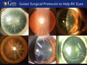 An eye with post- Radial Keratotomy (RK) complications, showing corneal irregularities and vision distortion before undergoing Dr. Gulani’s advanced corrective surgery.